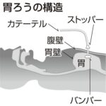 高齢者が誤嚥死したら介護施設を訴えれば２０００万円超が貰える状況に介護医療業界が震撼「老人は全員両手拘束して胃ろうにしなければ」