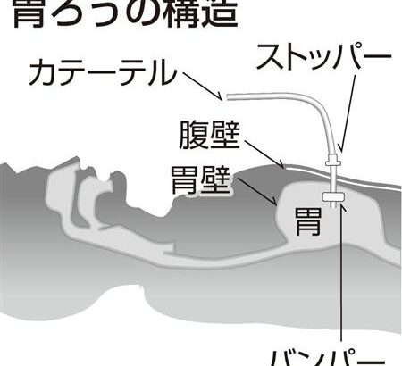 高齢者が誤嚥死したら介護施設を訴えれば２０００万円超が貰える状況に介護医療業界が震撼「老人は全員両手拘束して胃ろうにしなければ」